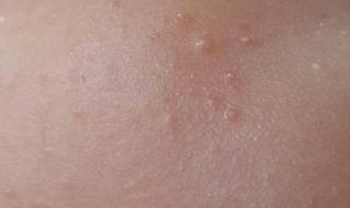 我脸上起小疙瘩小米粒大小,可以使用什么药解决才好 脸上长小疙瘩怎么办