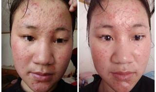 哪个医院的中医治痘痘效果好(广告勿进！) 祛痘最好的医院